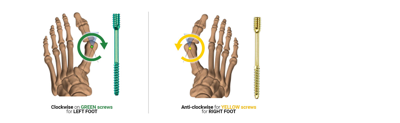 SURGIVAL-SURGIFEET-DIRECTION-SCREWS