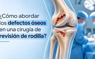 ¿Cómo abordar los defectos óseos en una cirugía de revisión de rodilla?