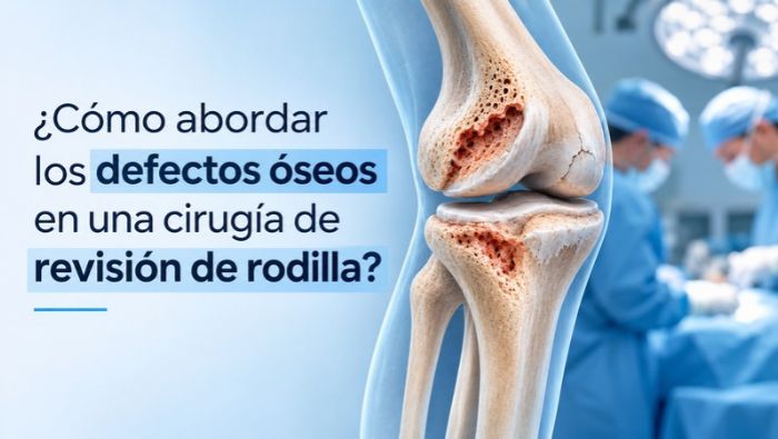 ¿Cómo abordar los defectos óseos en una cirugía de revisión de rodilla
